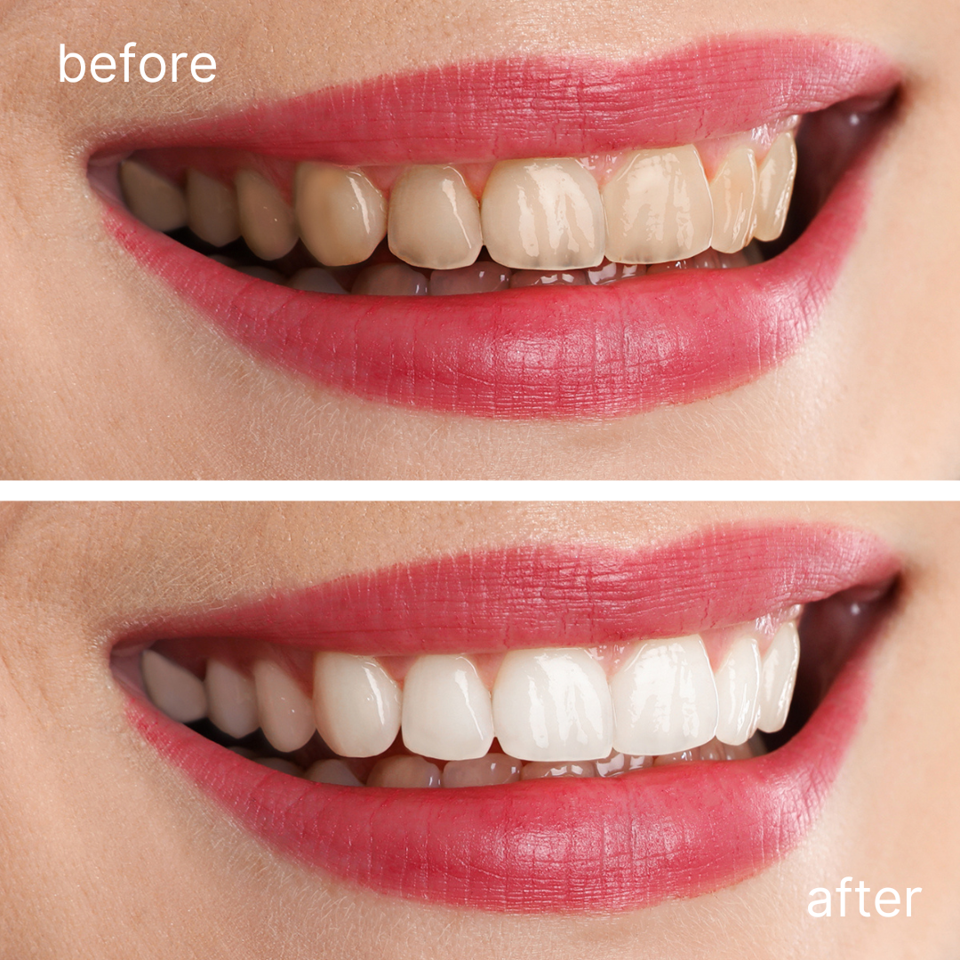 Before and after comparison showing teeth stained yellow and then noticeably whiter after stain removal using Ecosweetsmile