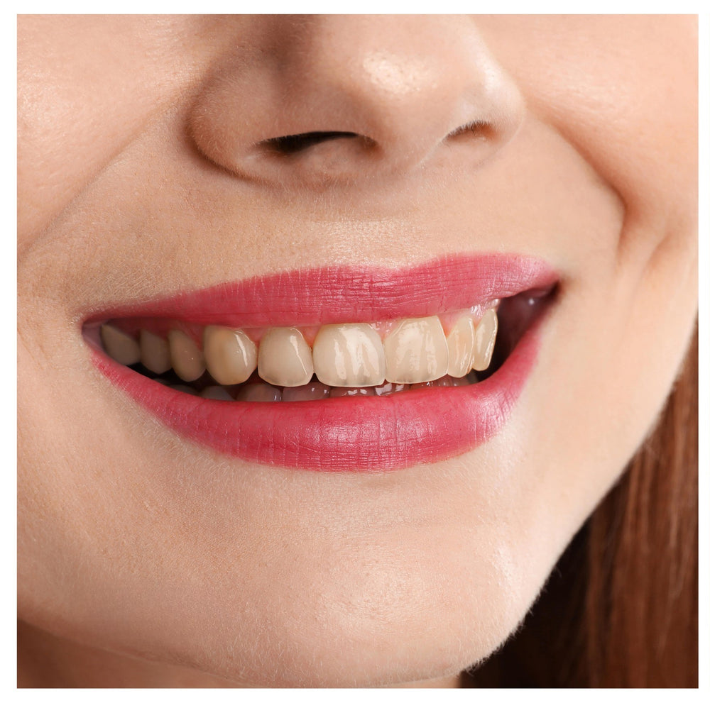 Before image of woman with yellow stained teeth from coffee, tea, wine, and smoking